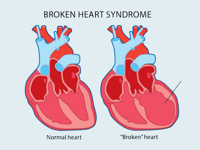 Can you fully recover from broken heart syndrome?