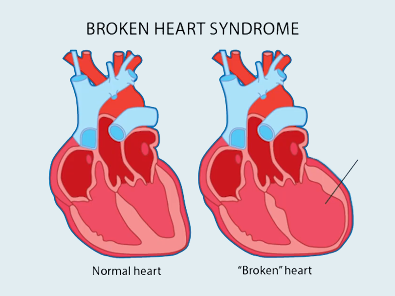 A diagram shows how the human heart can change shape under stress from a romantic loss.