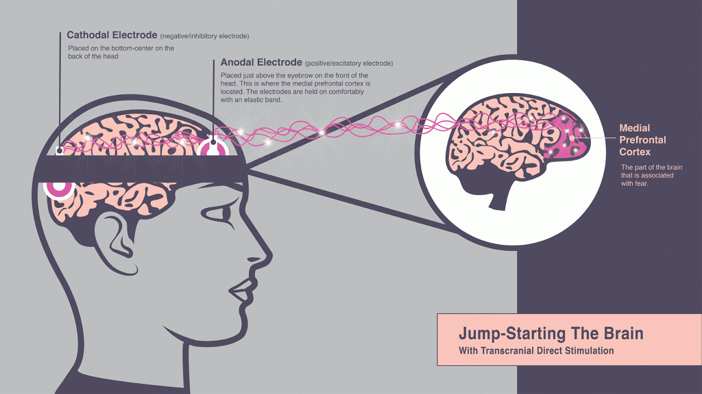 The Medial Prefrontal Cortex, which is the part of the brain associated with fear, is at the front of the brain by the forehead. The Cathodal Electrode is placed on the bottom-center on the back of the head, and the Anodal Electrode is placed just above the eyebrow on the front of the head where the medial prefrontal cortex is located. The electrodes are held on comfortably with an elastic band.