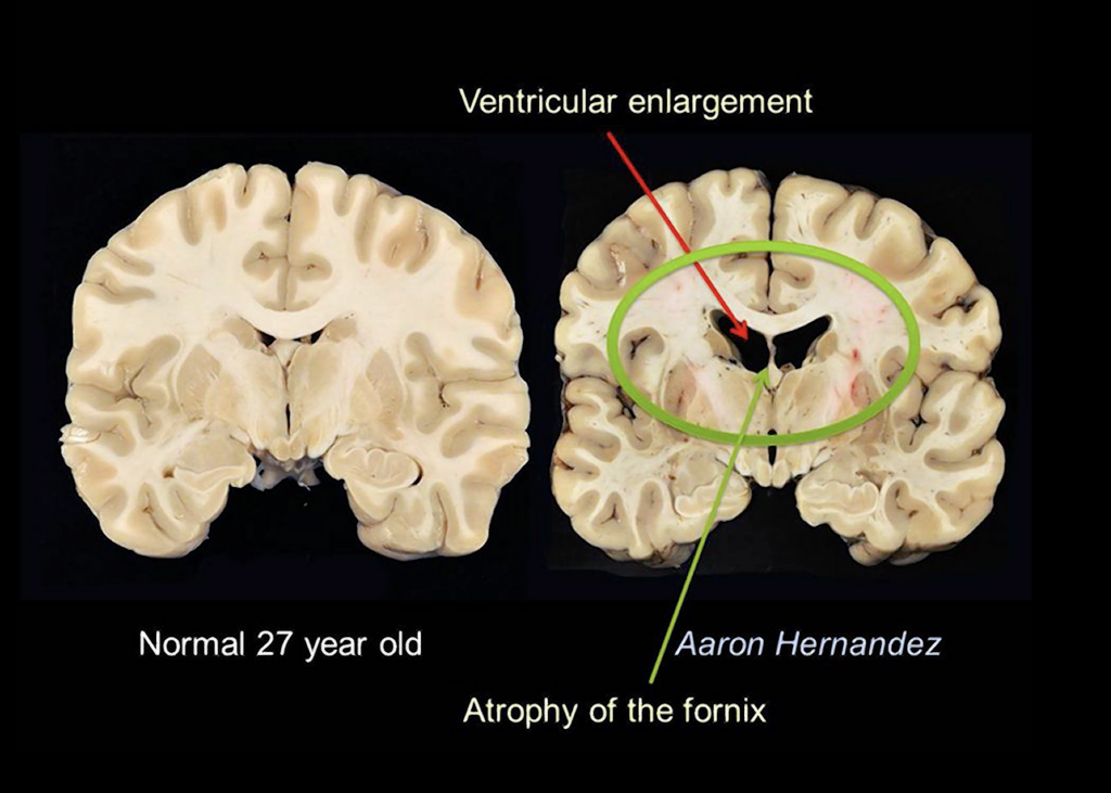 Two bisected brains are positioned next to each other. The brain on the left is the brain of a normal 27 year old and has very few dark spaces between its wrinkles. The brain on the right is the brain of Aaron Hernandez and has very prominent, dark spaces between its fold. Two arrows indicate ventricular enlargement and the atrophy of the fornix in the center of the brain.